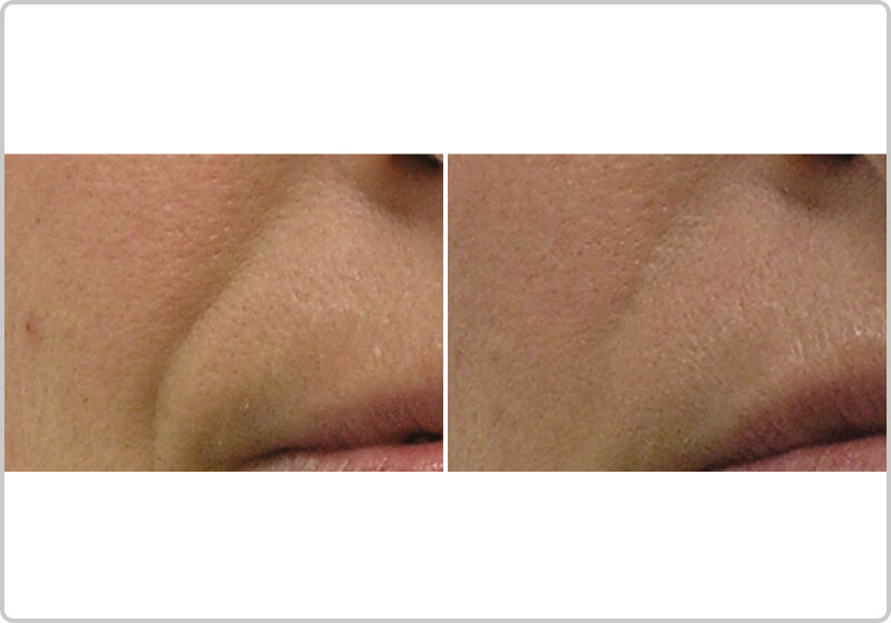 Before and after treatment of nasolabial folds