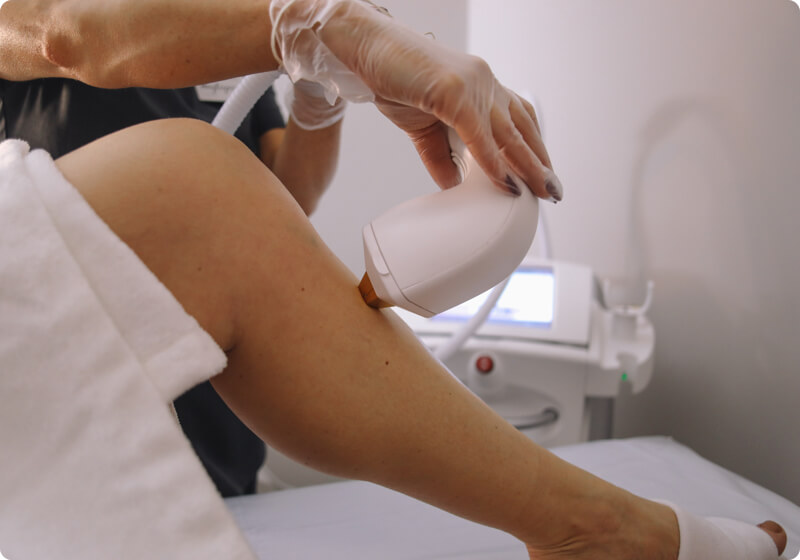 Therapist performing laser hair removal on a leg