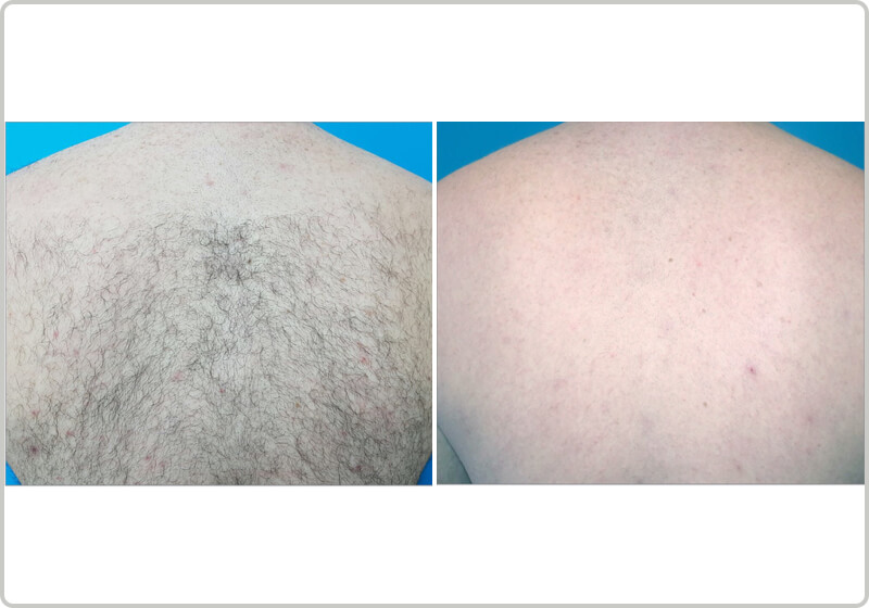 Before and after laser hair removal of the upper back