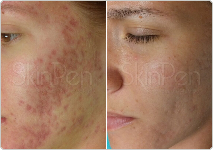 Before and after treatment of mirconeedling acne