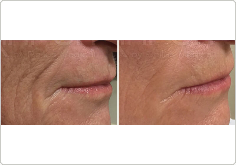 Before and after treatment of mirconeedling nasolabial folds