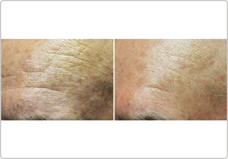 Before and after treatment of mirconeedling fine lines