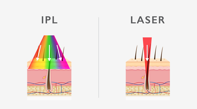 IPL, VPL and LASER hair removal- what's the difference?