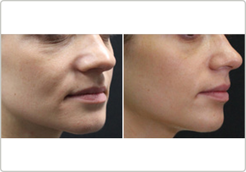 TriBella treatment before and after